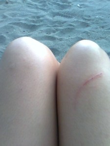 That's the huge scratch. I'm like an emo or something. LOL. 
